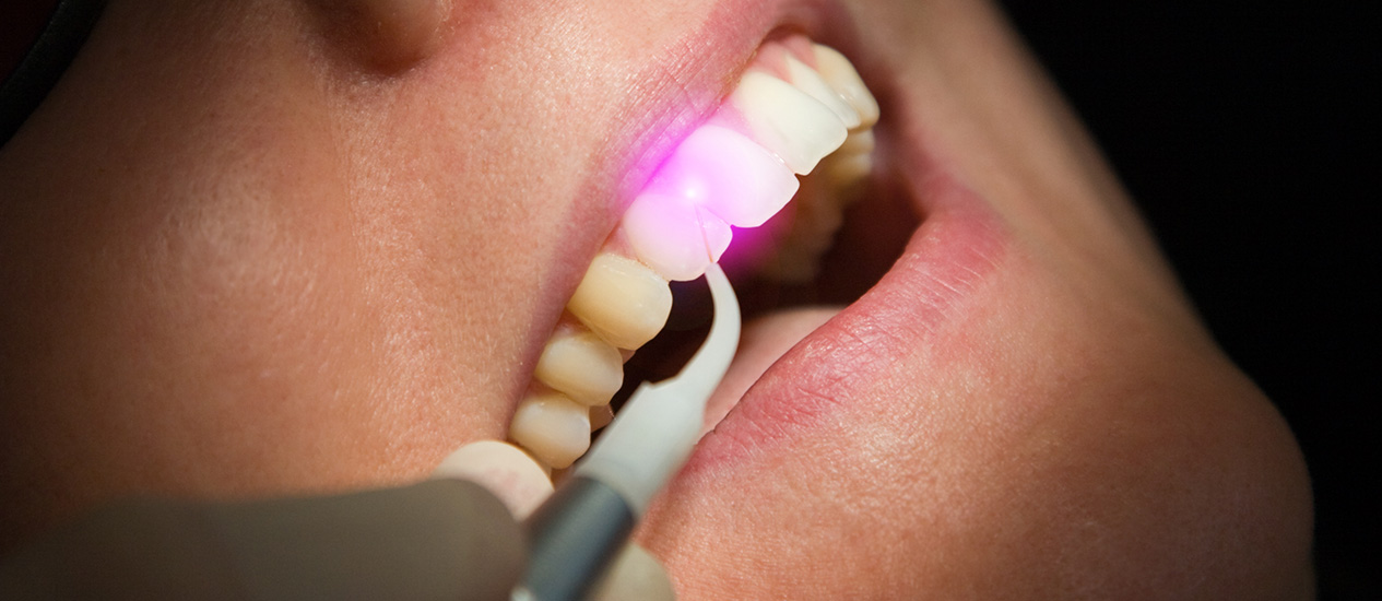 Lasertechnik, Zahnarzt Stuttgart